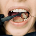 Wybielanie zębów: cena a jakość usługi